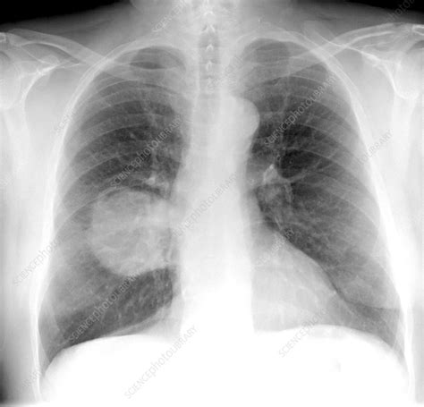 Lung Cancer X Ray Stock Image C0103403 Science Photo Library