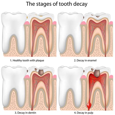 How To Fix A Cavity - Sockthanks29