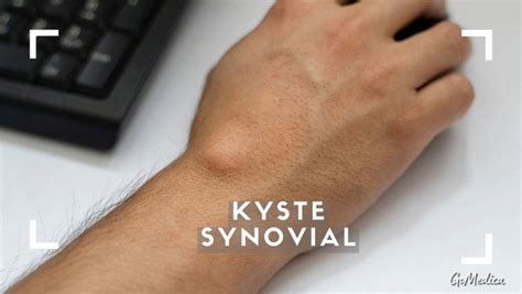 Comment Soigner Un Kyste Naturellement Synovial GoMedica