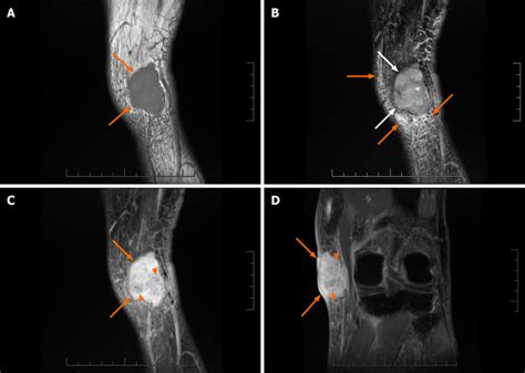 magnetic resonance images   malignant peripheral nerve sheath