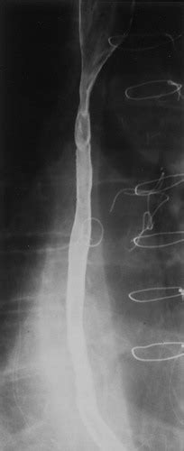 Radiologic Diagnosis Of Benign Esophageal Strictures A Pattern