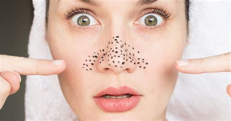 Как эффективно избавиться от черных точек?