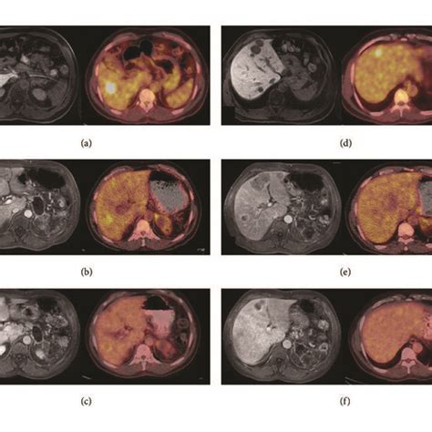 Magnetic resonance (MR) and positron emission tomography-computed ... 