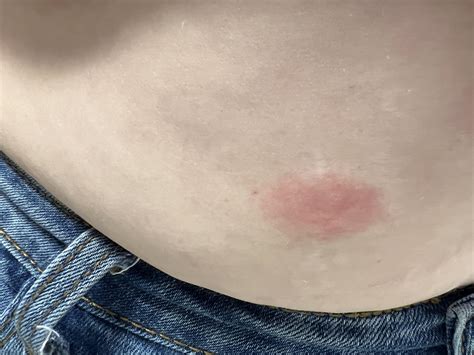 Injection site irritation? : r/Ozempic