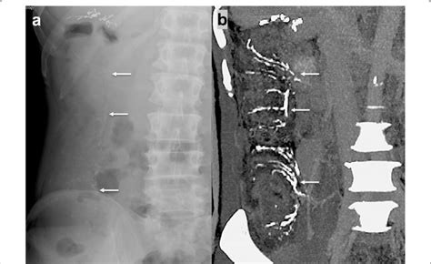 A Curvilinear Calcifications Alongside The Right Colon Seen On