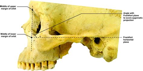 Neanderthal Zygomatic Arch