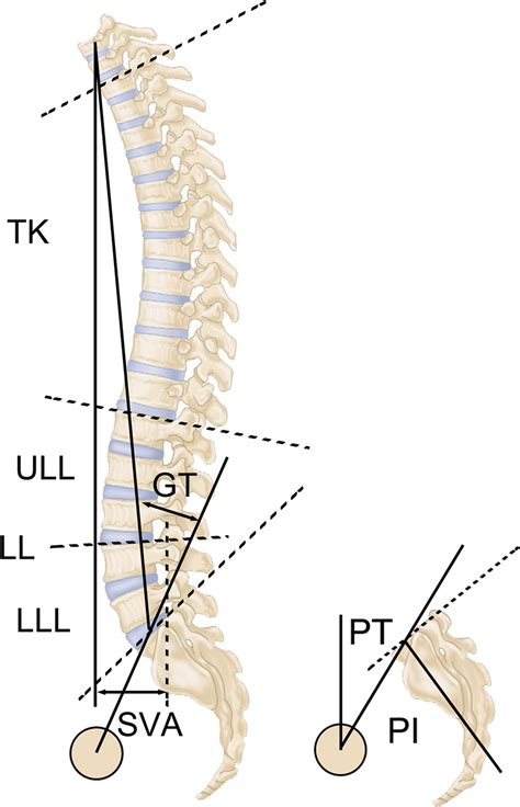 The Descriptions Of Sagittal Parameters Gt Global Tilt Sva Sagittal