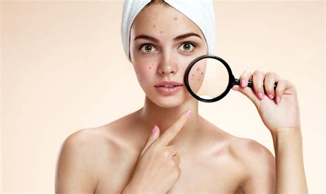 Acne in Women: Causes and Treatments – Miami Center of Excellence | Dr ...