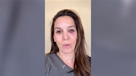 Christy Carlson Romano Shot In Face During Clay Pigeon Shooting