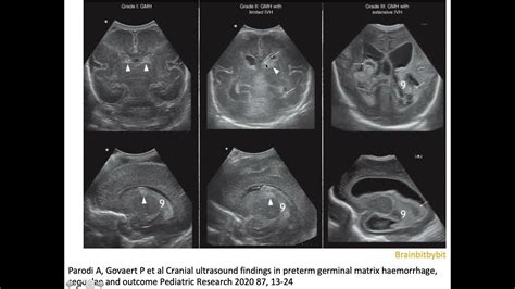 14 Intraventricular Hemorrhage Germinal Matrix Ivh Caudothalamic