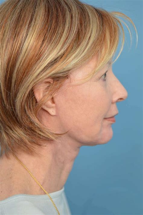 Before And After Dermabrasion In Ponte Vedra Beach Contoura
