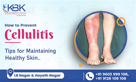 Cellulitis Diagnosis Archives Kbkhopitals