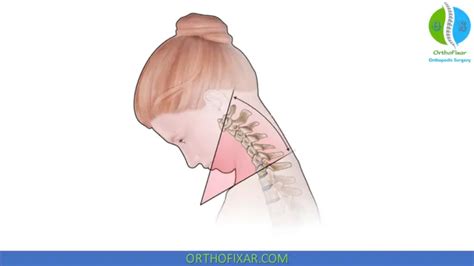 Cervical Spine Range Of Motion Orthofixar