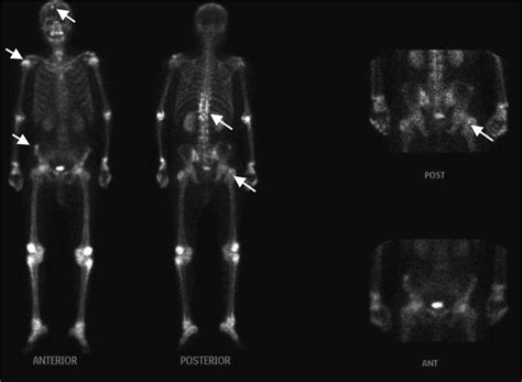 99m Tc Mdp Bone Scintigraphy Showed Multiple Lesions Of Increased