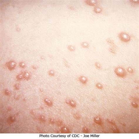 Chickenpox Pictures Symptoms Treatment And Prevention