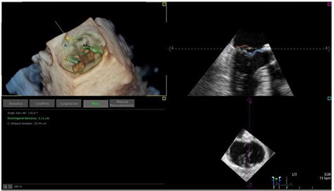 Frontiers Two And Three Dimensional Echocardiography In Primary