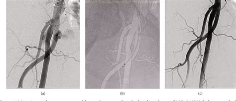 Figure From Viabahn Stent Graft Implantation For Iatrogenic