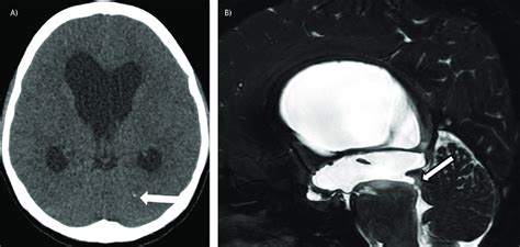 Brain Ct On Admission Shows Marked Dilatation Of The Lateral Ventricles Download Scientific