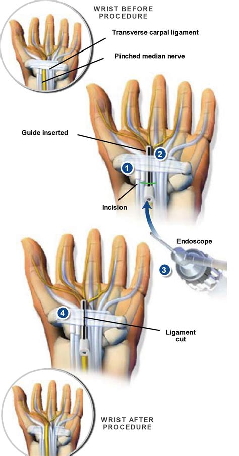 Endoscopic Carpal Tunnel Release