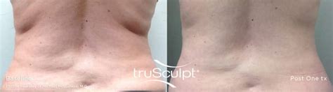 Body Contouring With Trusculpt Id Premier Ob Gyn And Med Spa Aesthetics