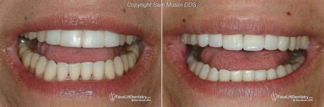 fake teeth   dental news network