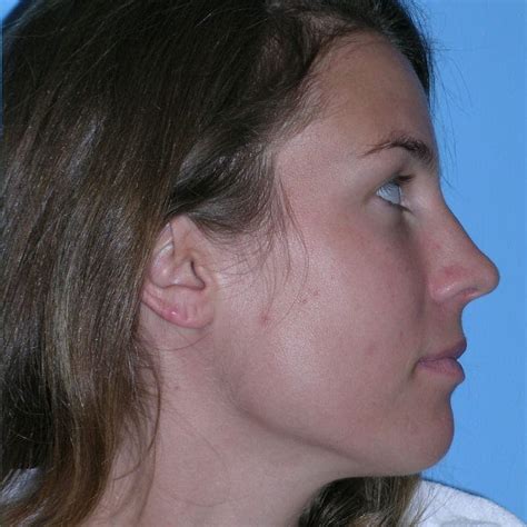 Patient 416596 Wide Nose Before And After Photos Dr Torkian Md