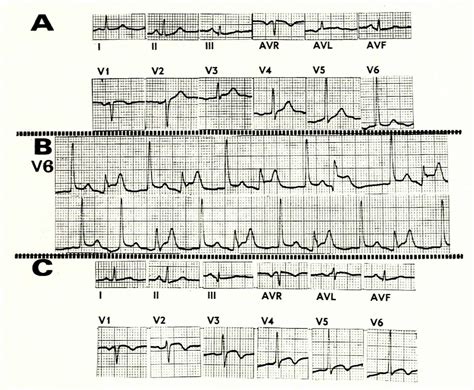 Figure 1 From Variant Prinzmetal S Form Of Angina Pectoris