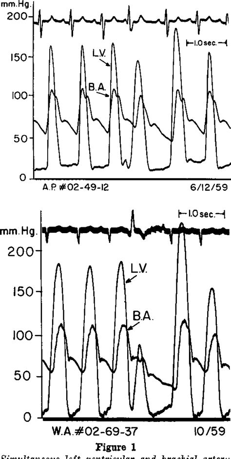 Figure 1 From A Hemodynamic Technic For The Detection Of Hypertrophic