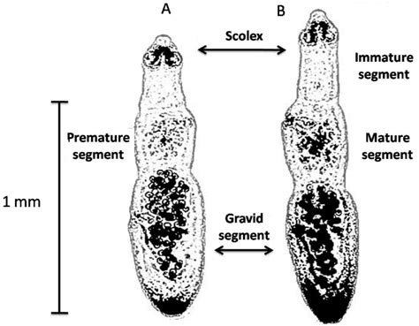 Echinococcosis Ct