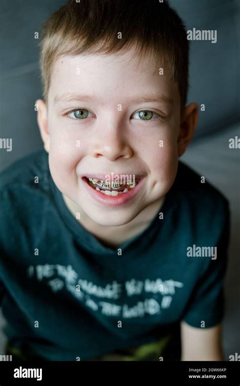 Boy With Braces Hi Res Stock Photography And Images Alamy
