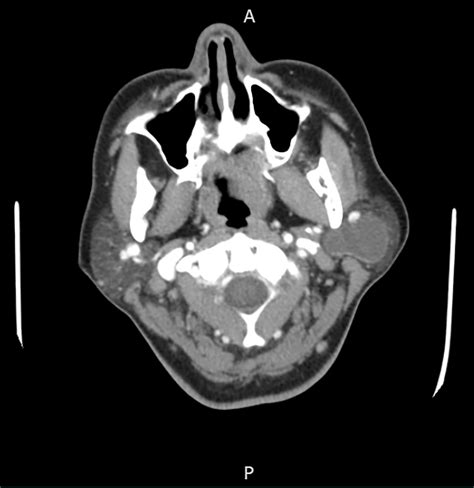 Benign Lymphoepithelial Lesion