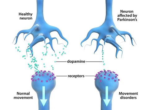 Parkinson's Disease / parkinson's disease may be stopped