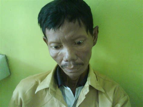 PUSKESMAS CIULU: PENYAKIT KUSTA