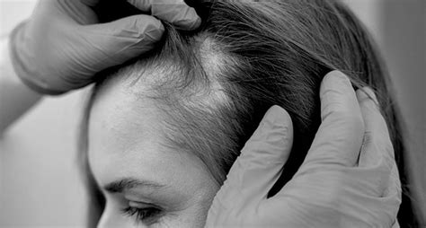 Alopecia cos è cause e trattamenti Doryanclinic