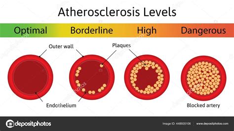 Niveles de aterosclerosis La acumulación de colesterol en los vasos