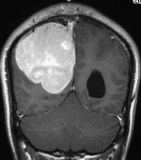 Thirty Nine Cases Of Intracranial Hemangiopericytoma And Anaplastic