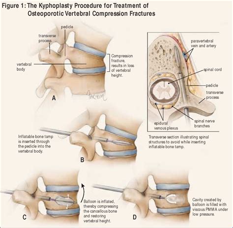 Figure From Kyphoplasty And Vertebroplasty For The Treatment Of