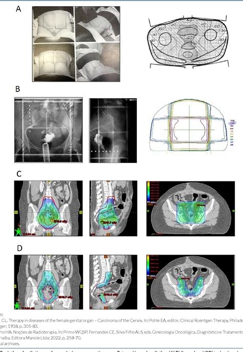 Figure 1 From History Of Radiotherapy In The Treatment Of Uterine