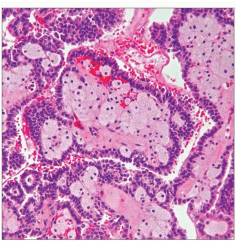 Papillary Renal Cell Carcinoma Basicmedical Key