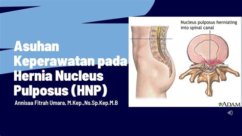 Asuhan Keperawatan Pada Hernia Nucleus Pulposus Hnp Youtube