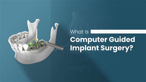 Computer Guided Implant Surgery Bayswater Dentist