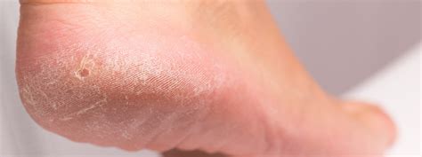 Treating Corns And Calluses Foot Health Beyond Podiatry
