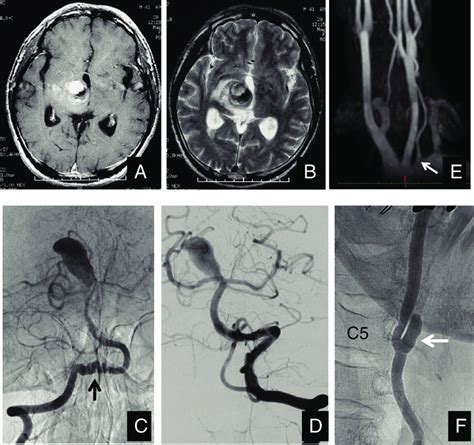 A And B Enhanced T A And T Weighted B Mri Show A Giant Aneurysm