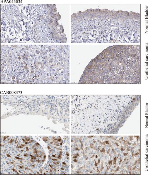 Over Expression Of Pttg1 Protein In The Urothelial Carcinoma Of The