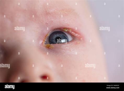 Blocked Tear Duct Baby