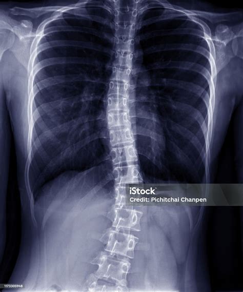 Xray Of Thoraciclumbar Spine In Dark Background Thoracolumbar Scoliosis