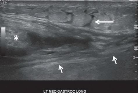 Medial Head of Gastrocnemius Muscle Tear | Radiology Key