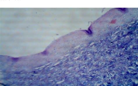 Figure 4 From An Unusual Presentation Of Nabothian Cyst A Case Report