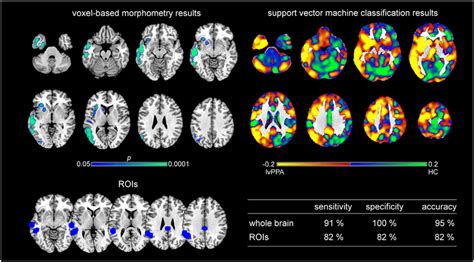 Voxel Based Morphometry And Support Vector Machine Classification