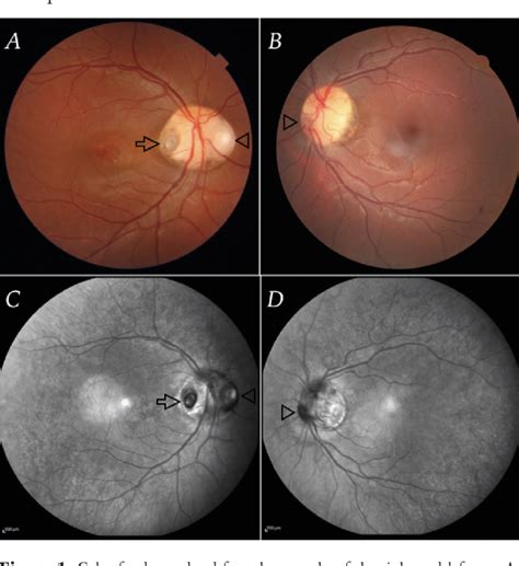 Figure From A Case Of Multiple Optic Disc Pits Year Follow Up